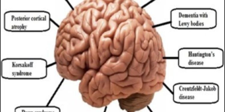 Alzheimer’s Disease