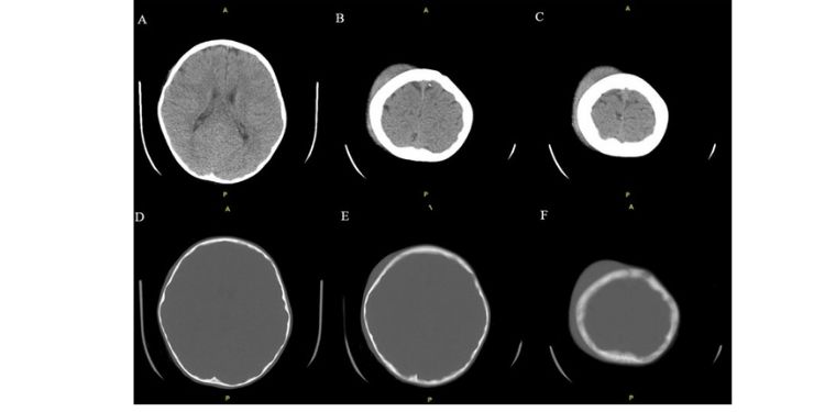 Article: Spontaneous Subgaleal Hemorrhage in a Child with Autism