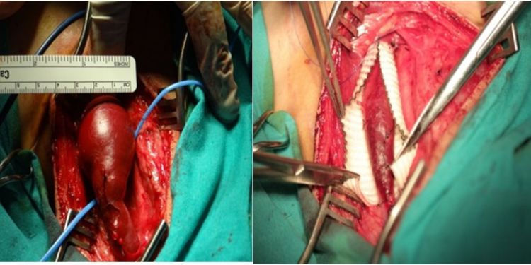Article: Internal Jugular Phlebectasia; A Challenging Neck Mass in Children